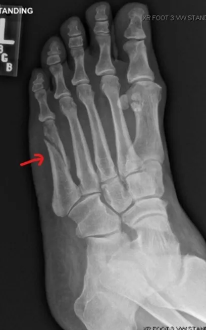 X-ray of a foot fracture after an accident