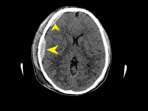 CT of the head showing bleeding after an accident, arrows marking the bleed