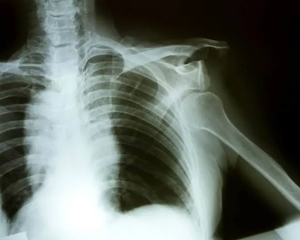 X-ray of a displaced shoulder fracture after an accident