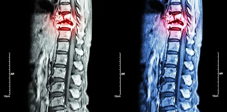 MRI showing a thoracolumbar spine fracture after an accident