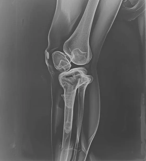 घिसे, अर्थराइटिक टख़ने के जोड़ की X-ray