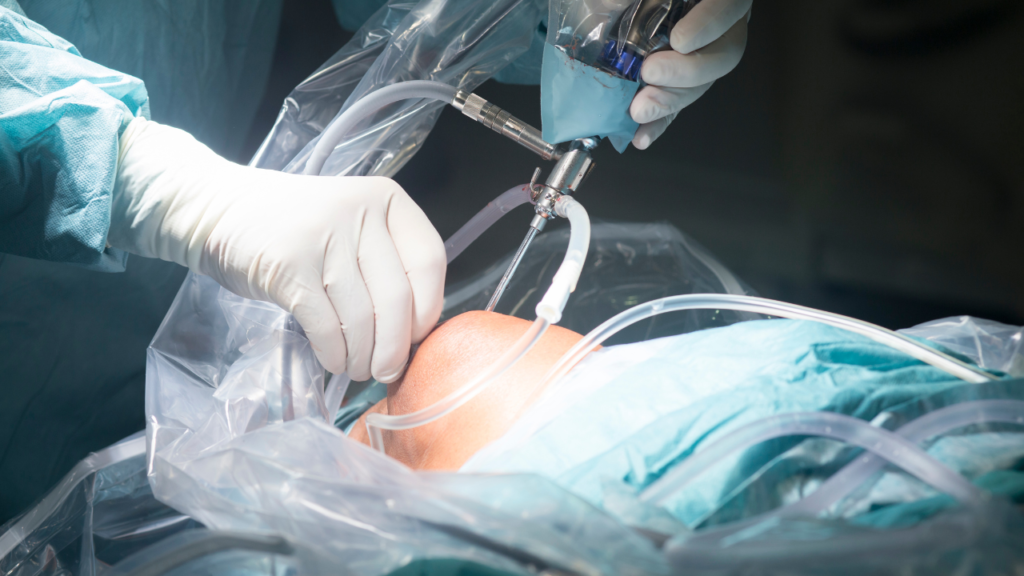Arthroscopy Surgery